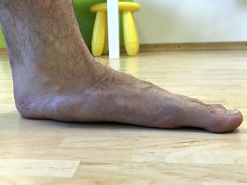 pied plat, source https://fr.wikipedia.org/wiki/Pied_plat#/media/Fichier:Flat_feet_(left).jpg