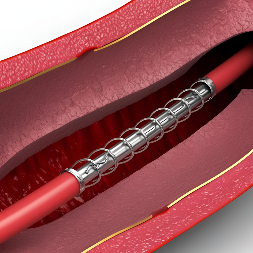 vue d'artiste, pour stent