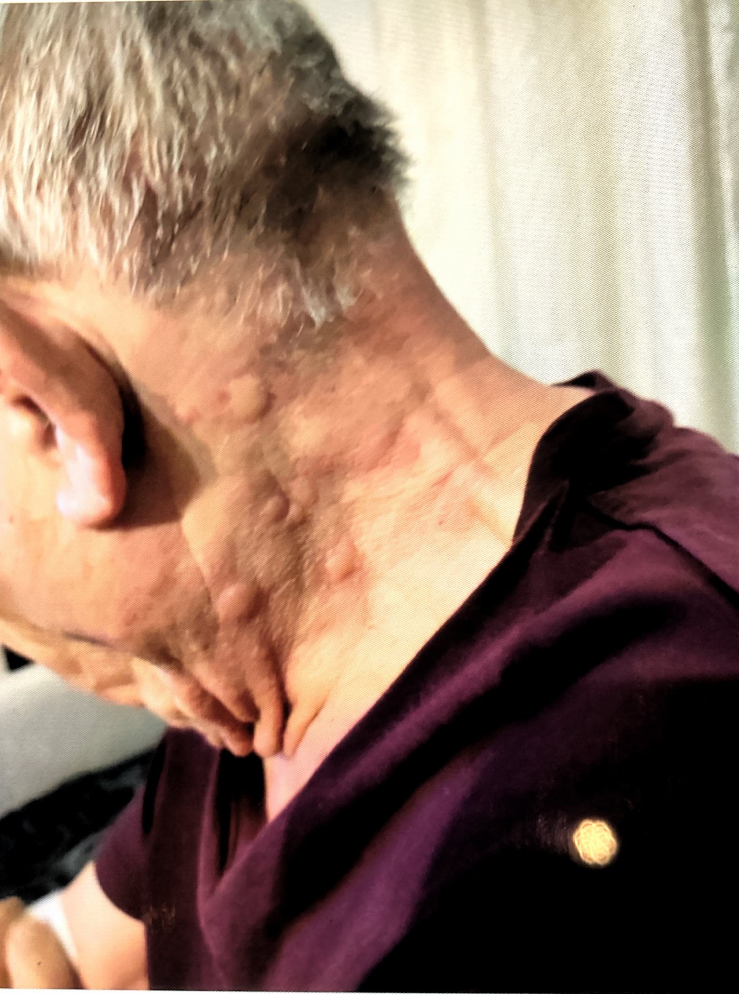 Plaques d'urticaire sur la peau